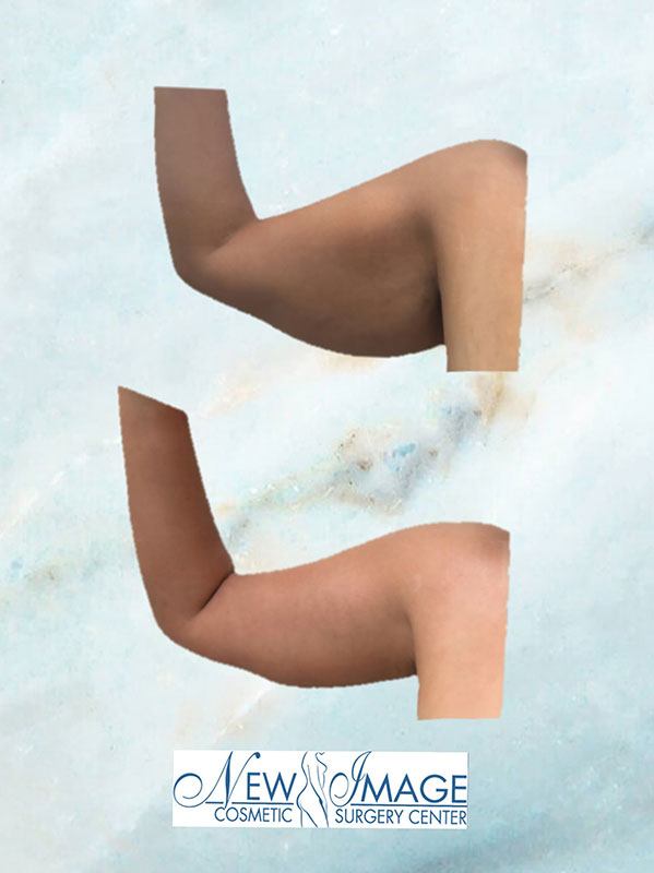 before and after arm lift at New Image Cosmetic Surgery Center