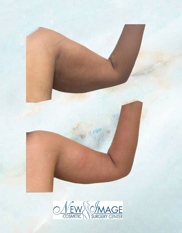 before and after arm lift at New Image Cosmetic Surgery Center