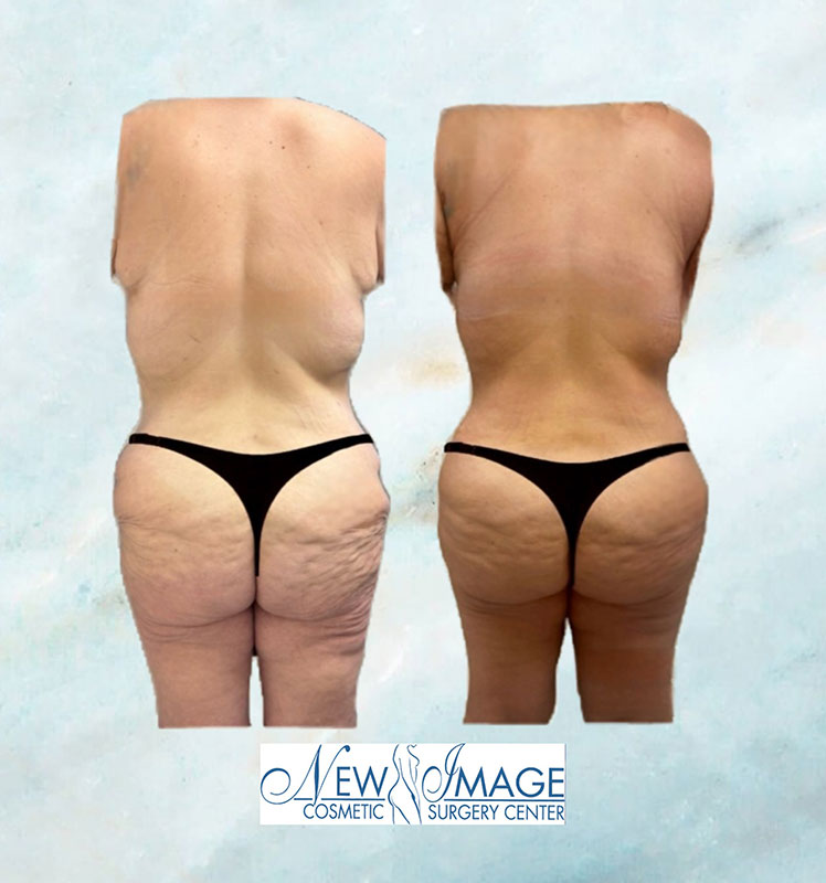 before and after BBL at New Image Cosmetic Surgery Center