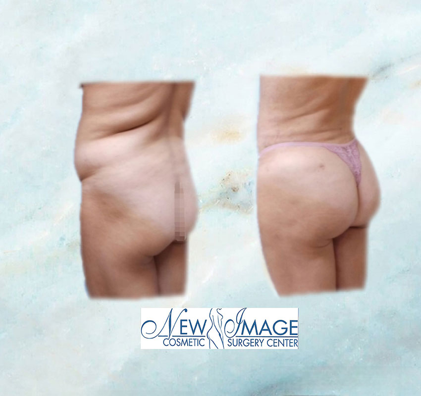 before and after BBL at New Image Cosmetic Surgery Center