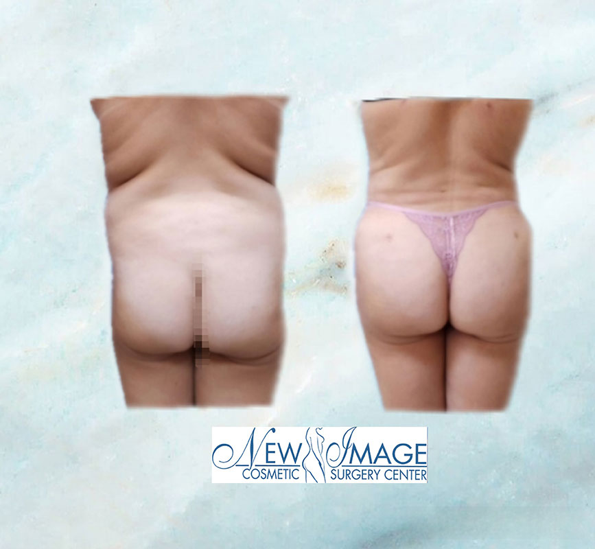 before and after BBL at New Image Cosmetic Surgery Center