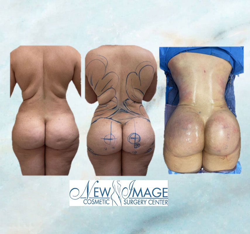 before and after BBL at New Image Cosmetic Surgery Center