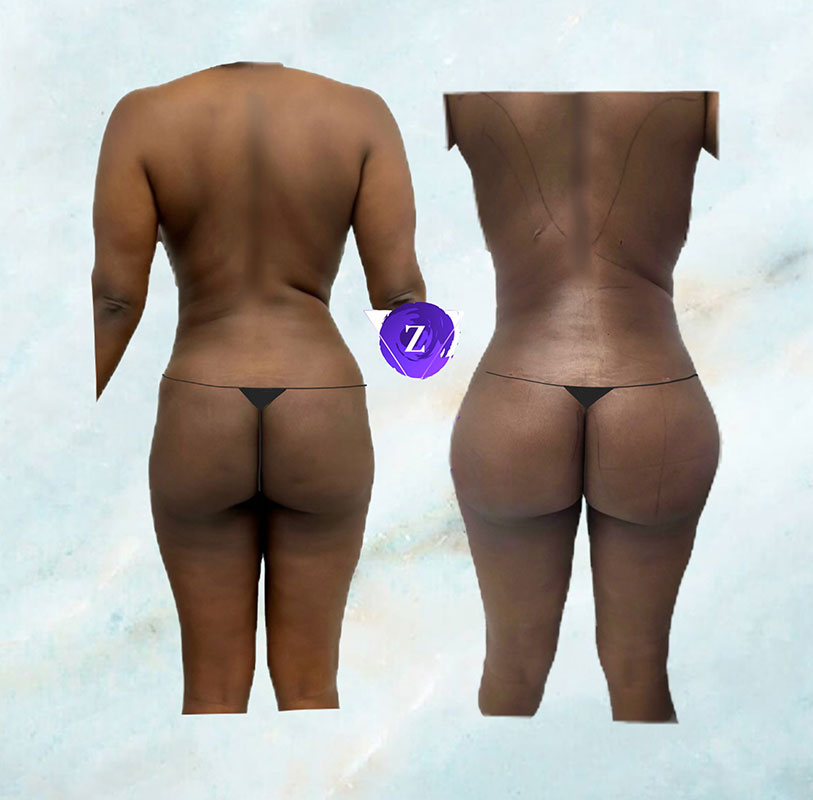 before and after BBL at New Image Cosmetic Surgery Center