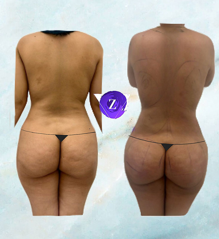 before and after BBL at New Image Cosmetic Surgery Center