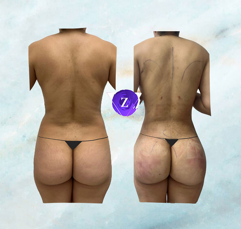 before and after BBL at New Image Cosmetic Surgery Center