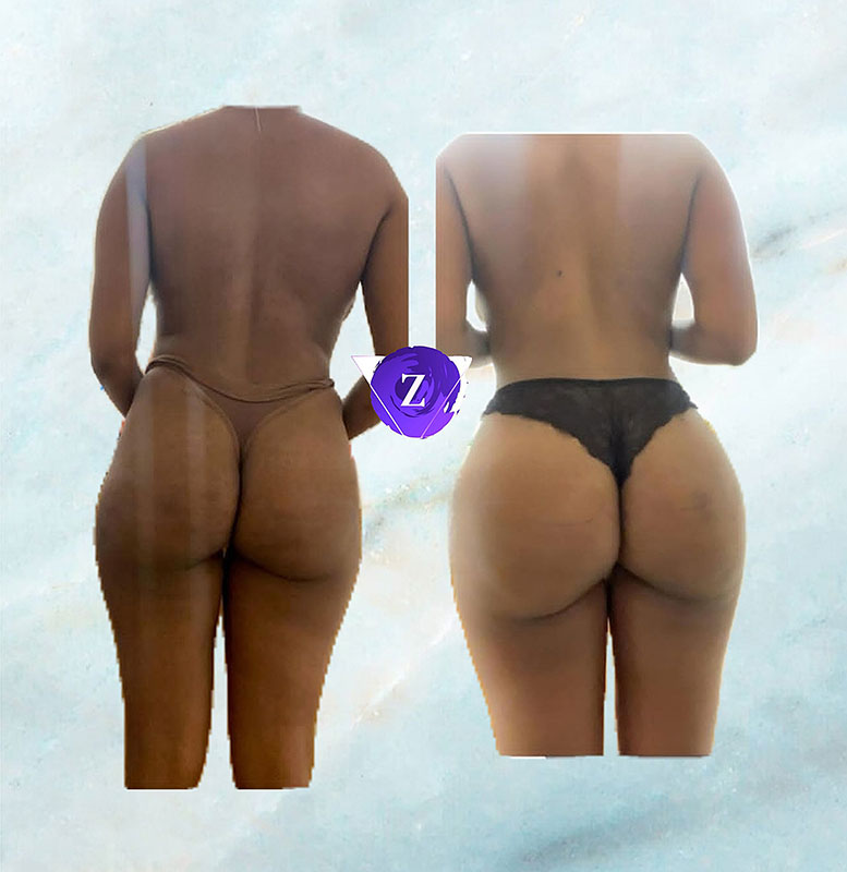 before and after BBL at New Image Cosmetic Surgery Center