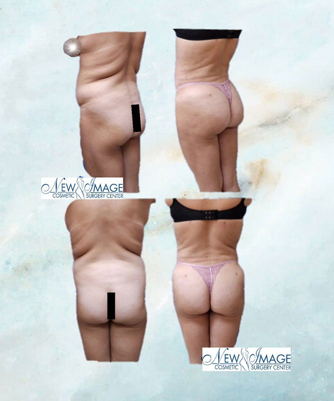 before and after BBL at New Image Cosmetic Surgery Center