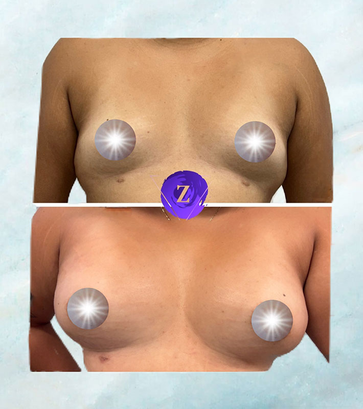 before and after breast augmentation at New Image Cosmetic Surgery Center
