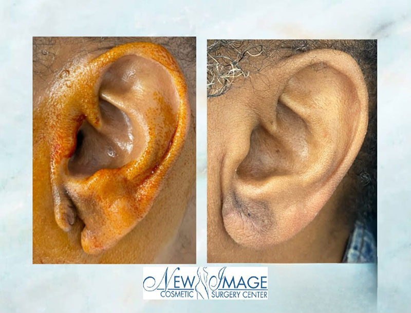 before and after earlobe repair at New Image Cosmetic Surgery Center