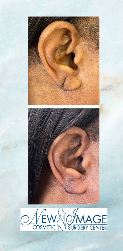 before and after earlobe repair at New Image Cosmetic Surgery Center
