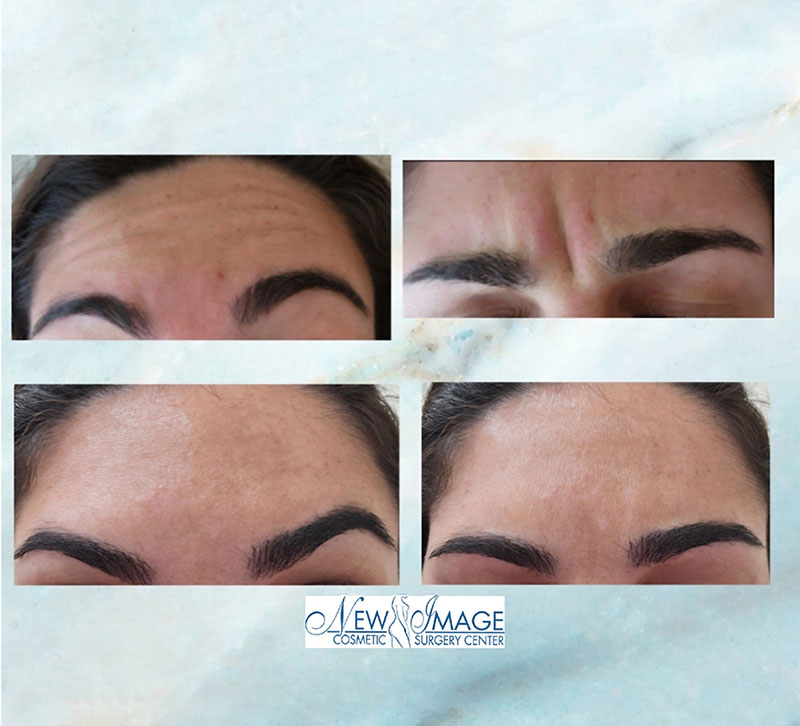 before and after injectables at New Image Cosmetic Surgery Center