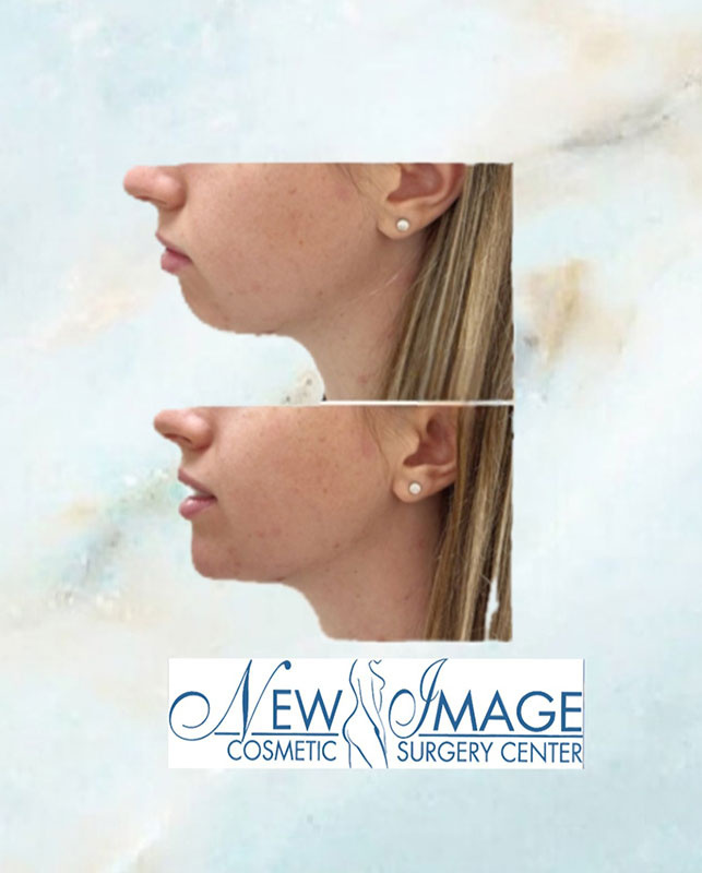 Before and after neck lift at New Image Cosmetic Surgery Center