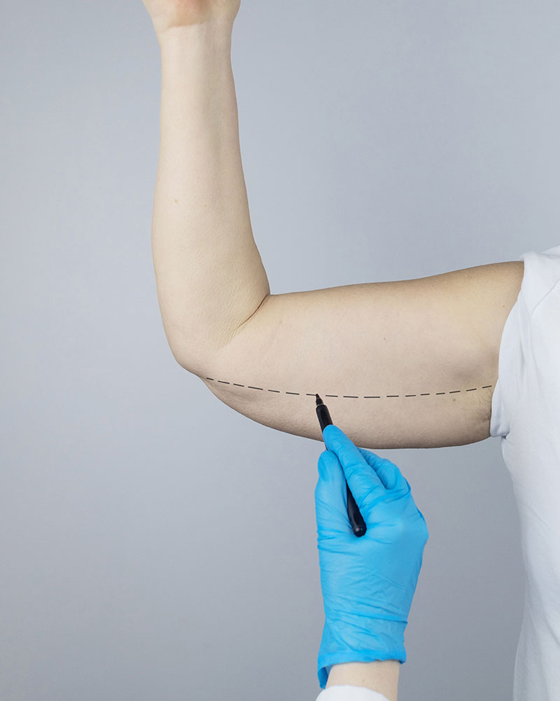 Arm lift in Fort Lauderdale and Plantation, FL