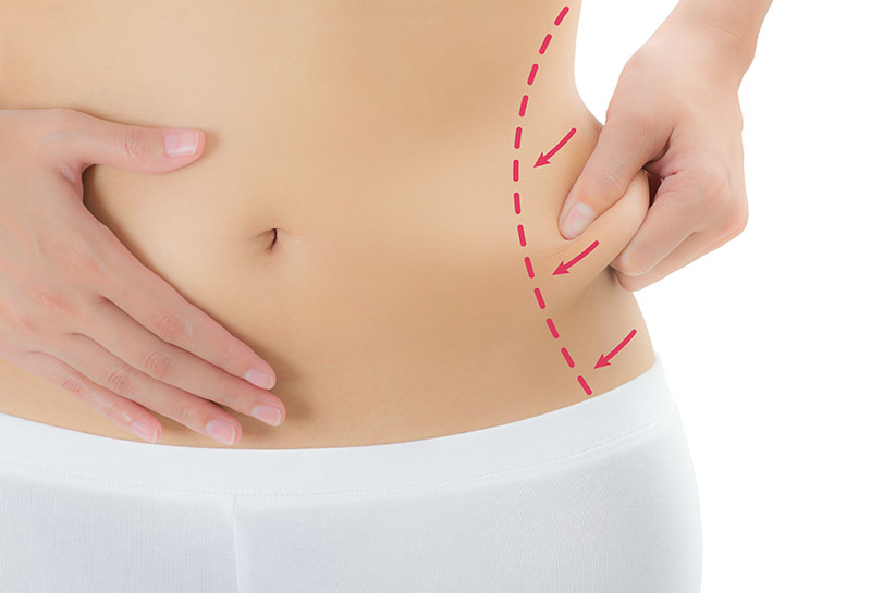 Liposuction in Fort Lauderdale and Plantation, FL